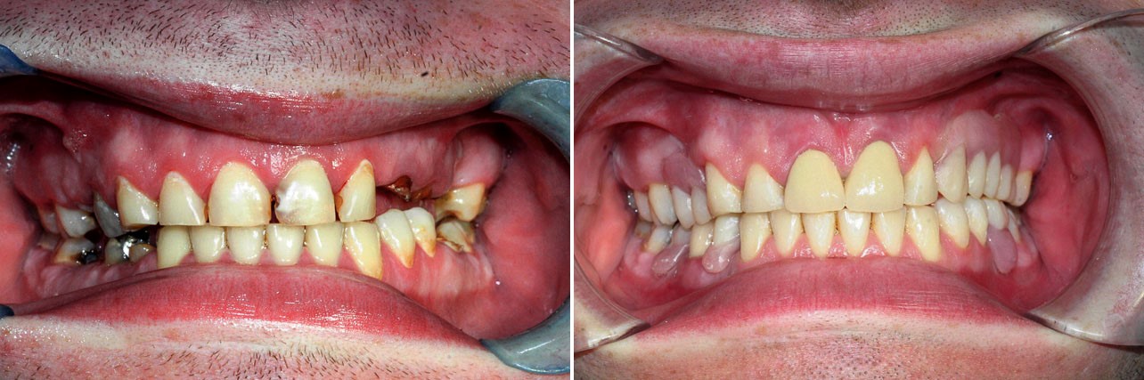 Partial Dentures Before And After Clear Creek WV 25044